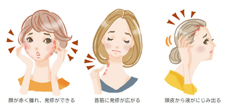 ヘアカラー後のかゆみ症状