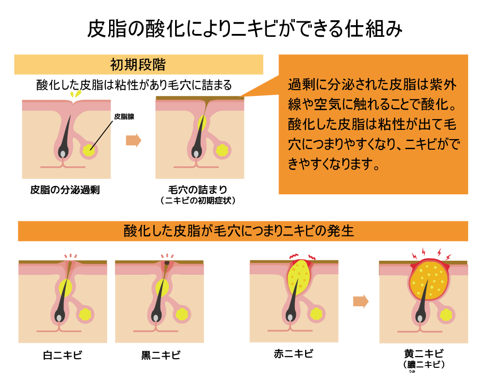 皮膚の酸化とニキビの関係